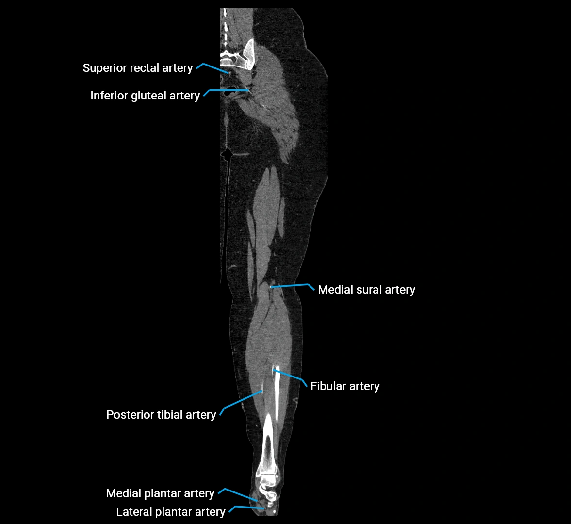 CTA lower limb coronal cross sectional anatomy labelled image _67 (2).webp